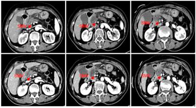Case report: A case study on the treatment using icaritin soft capsules in combination with lenvatinib achieving impressive PR and stage reduction in unresectable locally progressive pancreatic cancer and a literature review